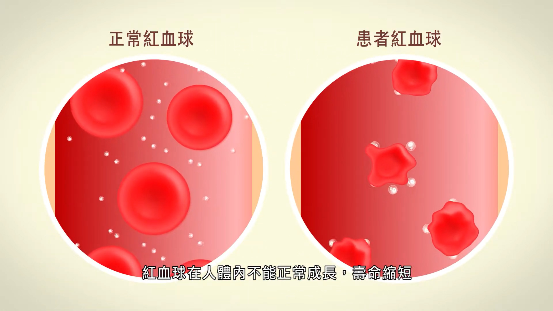Children Thalassaemia 00006